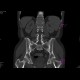 Crohn's disease with absesses, fistulae, and sacroileitis: CT - Computed tomography